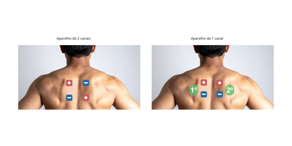 Image: Person using a TENS unit on their upper back

Alt: Pessoa utilizando aparelho TENS para alívio da dor dorsal