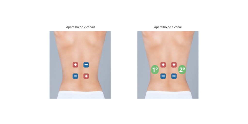 Image: Person using a TENS unit on their lower back

Alt: Pessoa utilizando aparelho TENS para alívio da dor lombar