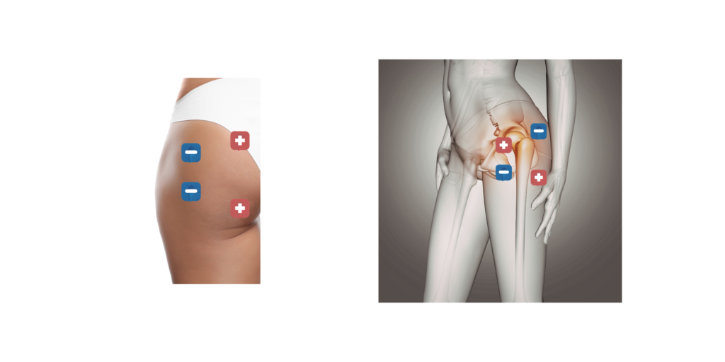 Image: Person using a TENS unit on their hips

Alt: Pessoa utilizando aparelho TENS para alívio da dor no quadril